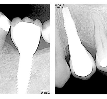 Clínica Dental Carlos Garde implantes