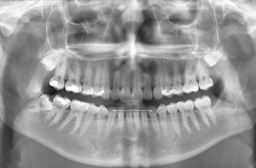 Clínica Dental Carlos Garde radiografía dental