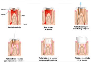 Clínica Dental Carlos Garde proceso de endodoncia